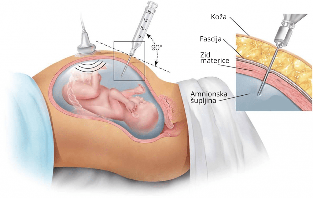 Izvođenje Amniocenteze kako bi se otkrio Daunov sindrom